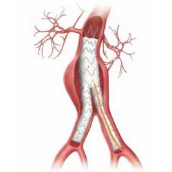 Cathéter à ballonnet pour greffe de Stents - 2