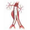 Stent graft balloon catheter - Cardiac surgery - 2