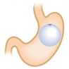 Intra gastric balloon - Gastroenterology - 4