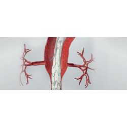 Endoprothèse thoracoabdominale E-nside TAAA - 5