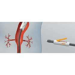 Endoprothèse thoracoabdominale E-nside TAAA - 6