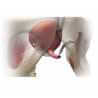 Sling for urinary incontinence - Urology - 1