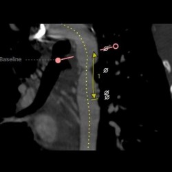 aortic surgery - Medical operations - 3