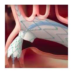 Aortic Arch Stent Graft System - Cardiac surgery -