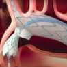 Aortic Arch Stent Graft System - Cardiac surgery -