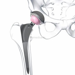 hip prosthesis - orthopedic surgery - 1