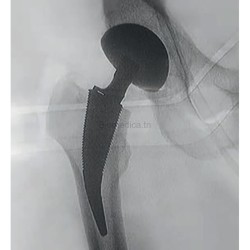 hip prosthesis - orthopedic surgery - 3