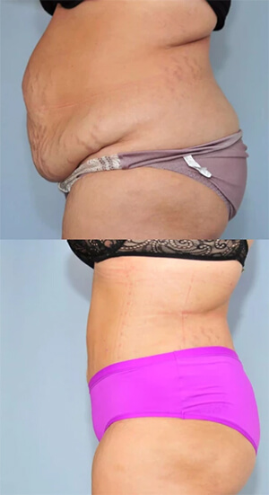 Abdominoplasty in Tunisia before/after