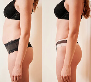 Abdominoplasty in Tunisia before/after