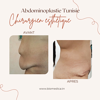 Abdominoplastie Avant-Après