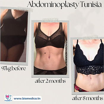 Abdominoplasty Before-After