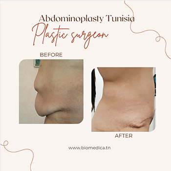 Abdominoplasty Before-After