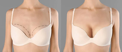 Tunisia breast augmentation by implant