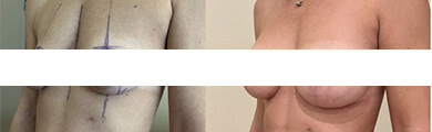 Tunisia breast augmentation by implant