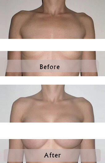 Tunisia breast augmentation by implant