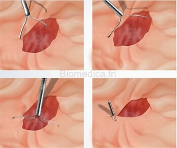 specifications clip hémostatique pour les hémostases endoscopiques