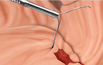 Single-use endoscopic hemostatic clip