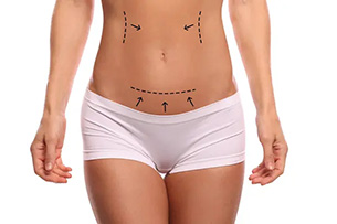 Liposuccion Tunisie – lipoaspiration – liposculture compléte