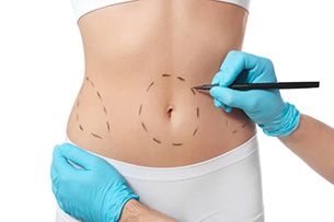 Liposuccion Tunisie – lipoaspiration – liposculture compléte