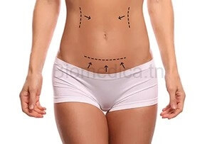 Liposuction Tunisia - liposuction - complete liposculture