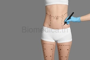 Liposuction Tunisia - liposuction - complete liposculture