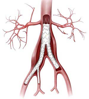 sale stent Tunisia