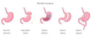 bariatric surgery