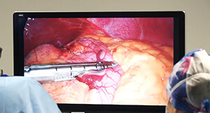 Sleeve Gastrectomy in Tunisia